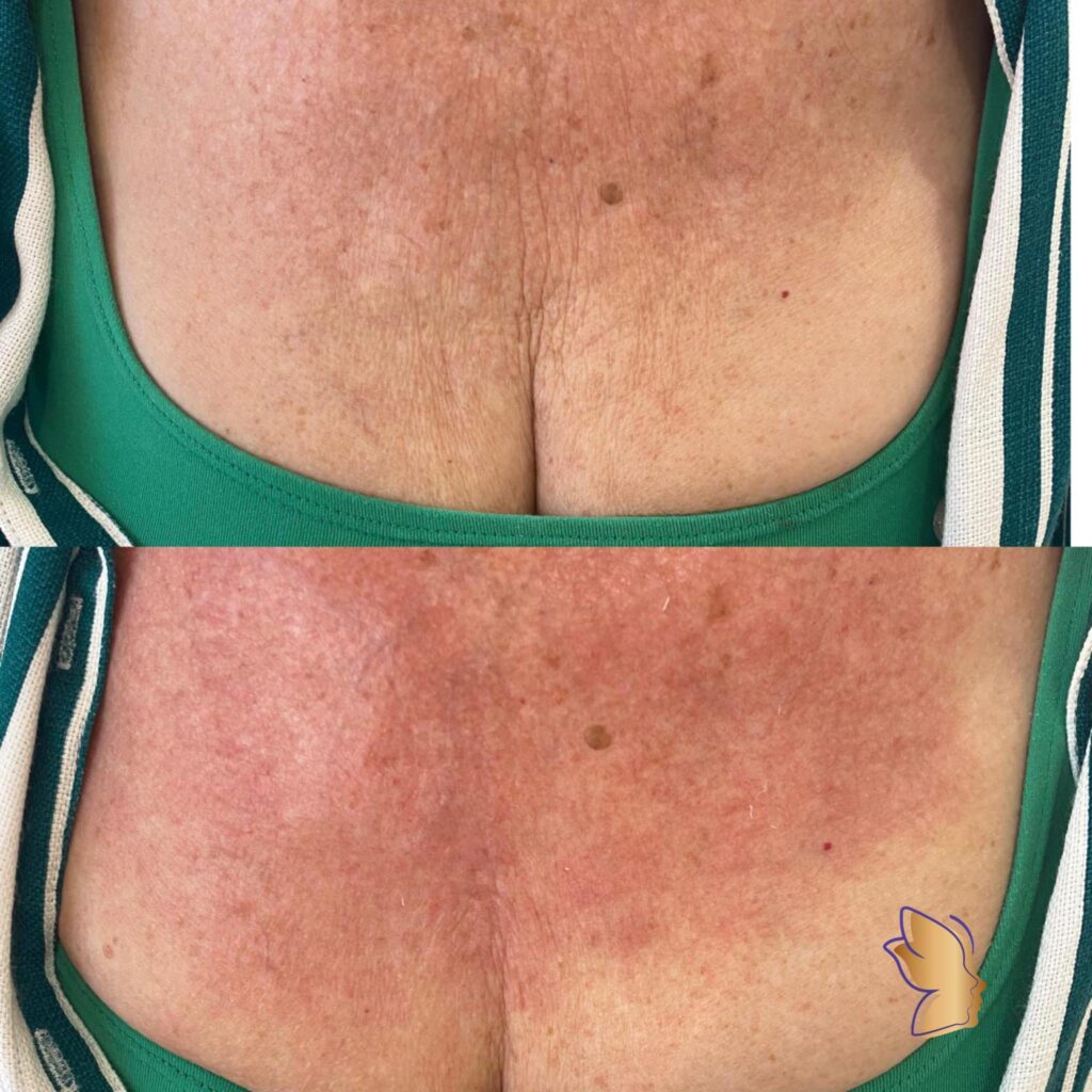 Bioestimulador de colageno 2