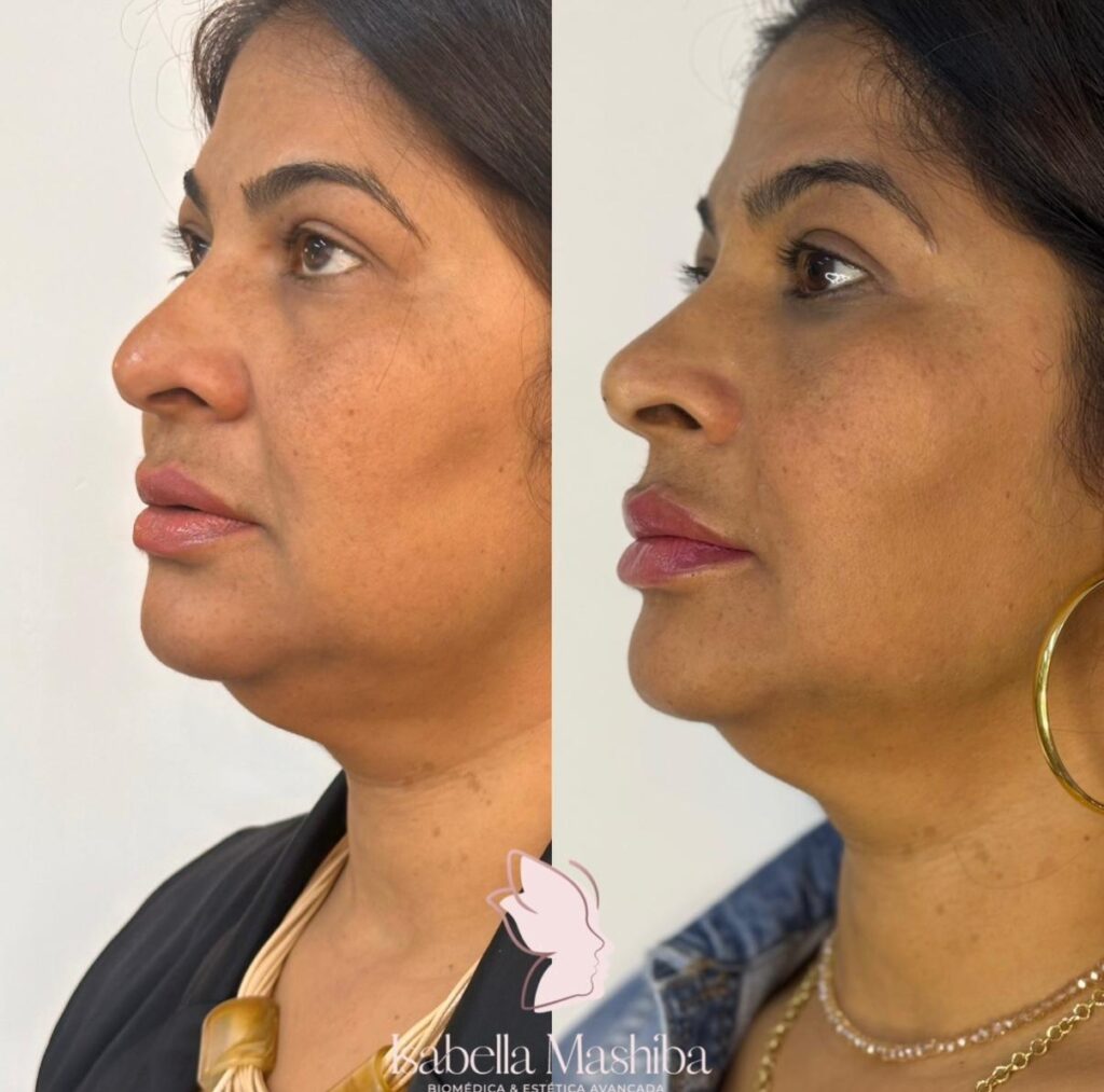 Bioestimulador de colageno 3