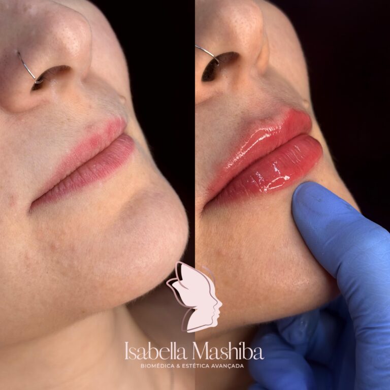 Preenchimento labial 01