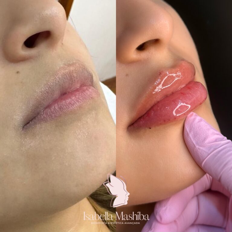 Preenchimento labial 02
