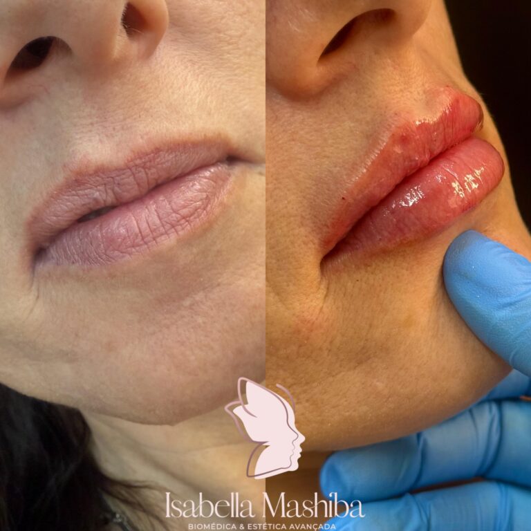 Preenchimento labial 03