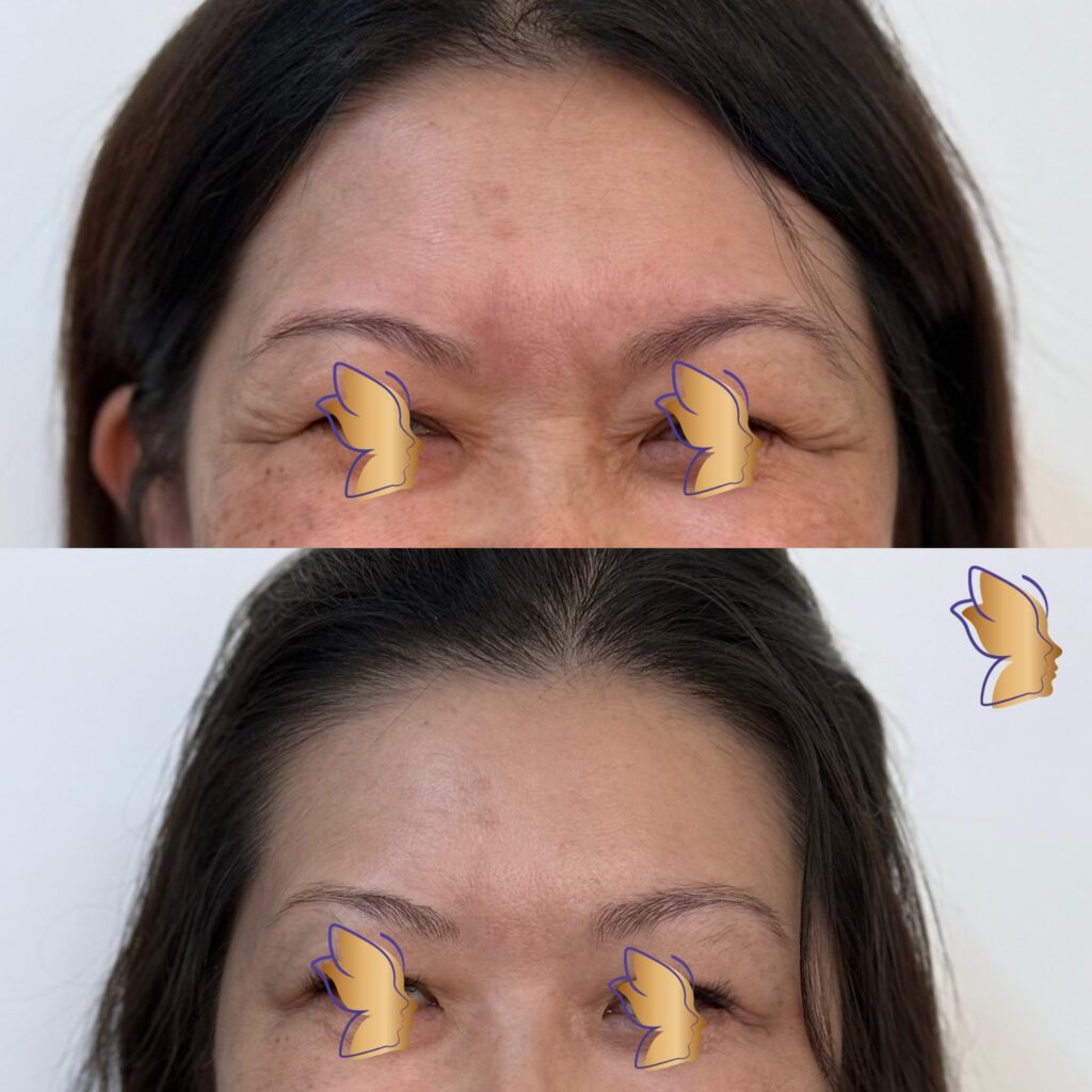 botox 1