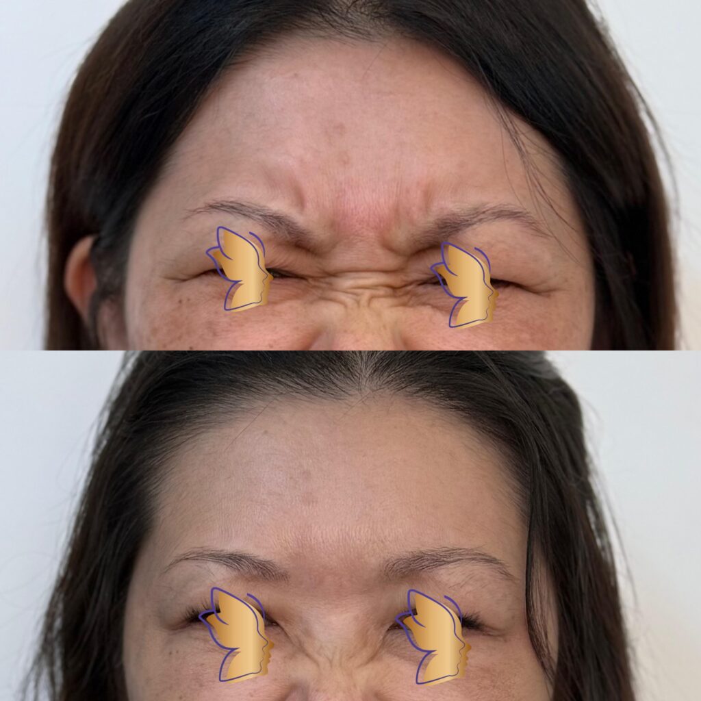 botox 2