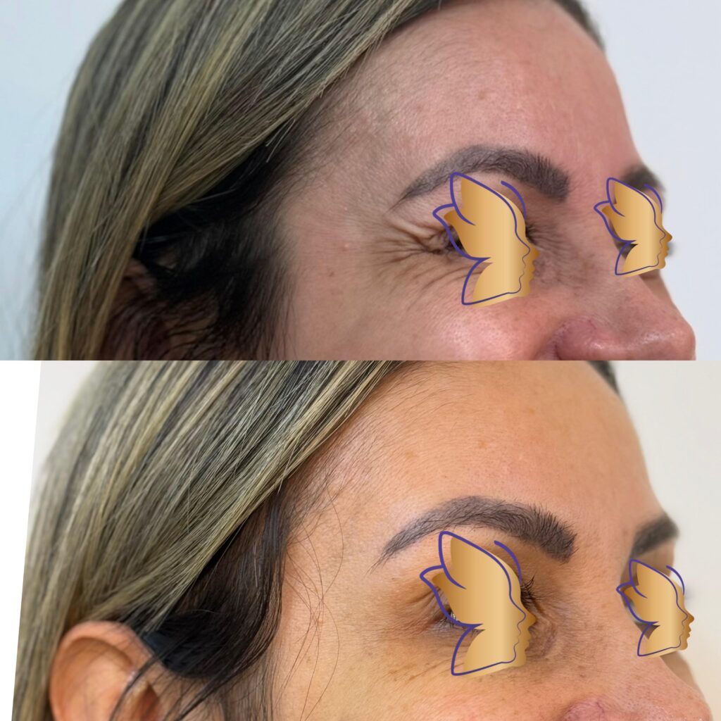 botox 3