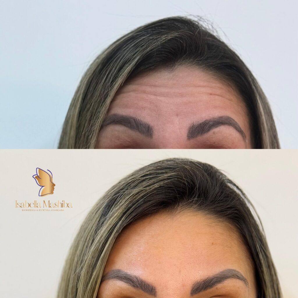 botox 5